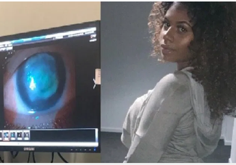 Pakai Soft Lens Saat Berenang di Laut, Remaja 19 Tahun ini Mendadak Buta dan Terkena Infeksi Langka