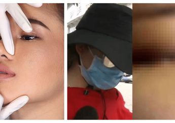  Suntikkan Cairan Ke Hidung Dengan Harapan Menjadi Lebih Mancung, Remaja 18 Tahun ini Justru Alami Kebutaan Permanen