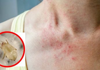 Bahaya Tungau Debu yang Hidup di Kasur dan Bisa Sebabkan Alergi, Usir dengan Memanfaatkan Bahan Dapur!