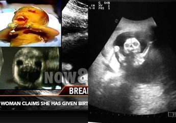 Saat Hamil Perutnya seperti Dicakar, Ibu ini Lahirkan 'Bayi Setan' yang Mampu Bertahan Dalam Kandungan Tanpa Air Ketuban