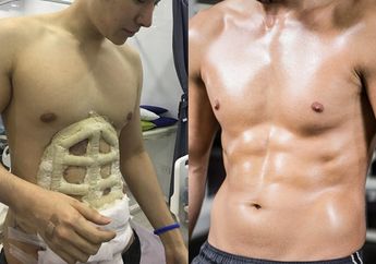 Demi Punya Perut Berotot Secara Instan, Tren Operasi Six Pack Diburu Pria di Thailand