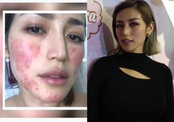 Sempat Alami Iritasi Wajah Parah, Jessica Iskandar Kapok Terima Sembarang Endorse Kecantikan!