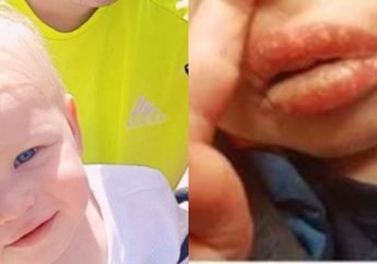 Idap Penyakit Ini, Bibir Balita 1 Tahun Melepuh dan Mengeluarkan Cairan hingga Nyaris Membuatnya Meninggal!