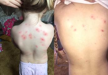 Bagikan Tips Obati Cacar Air Menggunakan Sampo, Unggahan Ibu ini Mendadak Viral