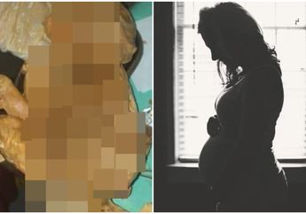 Alami Sakit Perut Parah, Wanita Ini Tak Sadar Mengandung Bayi yang Sudah Meninggal dalam Perutnya Selama 15 Tahun!