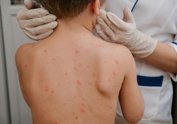 Penderita yang Sudah Pernah Alami Cacar Air Bisakah Terkena Penyakit yang Sama Dua Kali? Simak Penjelasan Ahli