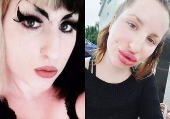 Terobsesi Punya Bibir Besar, Wanita ini Ketagihan Lakukan Filler Hingga Rela Habiskan Rp34 Juta