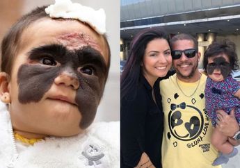 Kisah Pengorbanan Seorang Ibu: Pergi ke Rusia hingga Siapkan Dana Rp 2,8 Miliar untuk Operasi Wajah Anaknya yang seperti Memakai 'Topeng Batman'