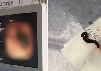 Ada 2 Lintah Tumbuh di Tenggorokan dan Hidung Pria Ini, Tak Disangka Awalnya Hanya Sepele Seperti Ini