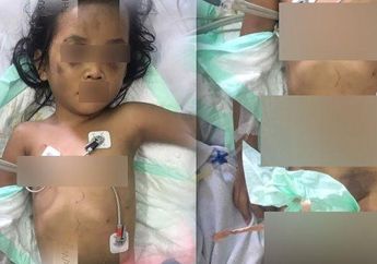 Bocah 4 Tahun Alami Luka Lebam di Sekujur Tubuh, Pengakuan Orang Tua Berbelit dan Sebut Keracunan Obat, Berikut Fakta-faktanya