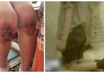 Gara-gara Dihukum Orangtuanya, Kaki Bocah Ini Alami Hal Mengerikan hingga Harus Dioperasi