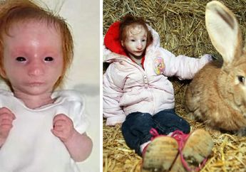 Terlahir Dalam Ukuran Hanya Sebesar Kelinci, Dokter Sebut Bayi Ini Hanya Bisa Bertahan 1 Tahun, Tapi 12 Tahun Berlalu Secara Ajaib Begini Kondisi Gadis Ini