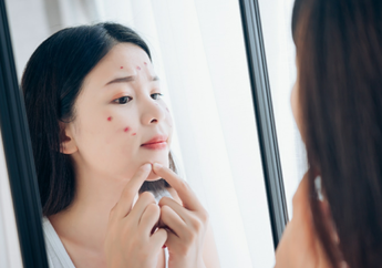 Kulit Kering Tapi Berjerawat? Jangan Bingung, Ketahui Penyebabnya Di Sini!