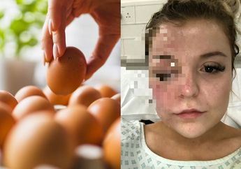 Wanita ini Alami Luka Bakar pada Wajahnya karena Memasak Telur dengan Microwave Hingga Meledak