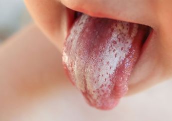 Sariawan pada Bayi, Begini Cara Perawatannya yang Biasanya Sembuh Tanpa Perlu Obat Kimia