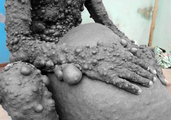 'Ribuan Benjolan Misterius' Seberat 25 Kg Mendadak Jalari Tubunya, Pria Ini Kehilangan Pekerjaan, Dibuang, dan Dipaksa Pakai Topeng Agar Masyarakat Tidak Jijik 