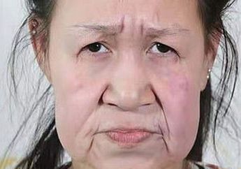 Dilu Jadi Bahan Olokan Karena Gadis 15 Tahun Ini Wajahnya Keriput dan Melorot, Setelah Operasi Penampilannya Bikin Melongo