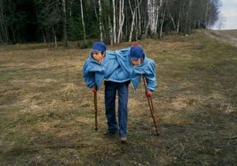 Tragisnya Kehidupan Kembar Gancet Ini, Dianggap Aneh Sejak Bayi Mereka Dijadikan Bahan Eksperimen Brutal, di Akhir Hidupnya Meninggal dengan Cara Memilukan