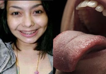 Nyawa Artis FTV ini Melayang karena Kanker Lidah, Waspada Makanan Panas Bisa Jadi Pemicunya!