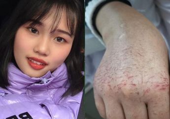 Tangan Perawat Cantik di Wuhan Ini Melepuh dan Menjadi Menakutkan karena Melakukan Hal Ini di Rumah Sakit