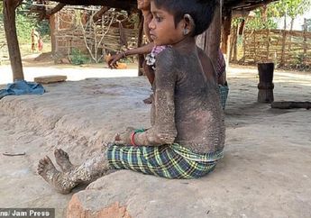 Tubuh Gadis 7 Tahun Ini Berubah Jadi 'Batu', Duduk Saja Kesakitan Apalagi untuk Jalan