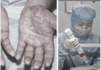 Bekerja Lebih dari 12 Jam Sehari, Dokter di Wuhan Sampai Alami Cedera di Tangan Hingga Melepuh dan Bengkak Demi Temukan Penangkal Virus Corona yang Semakin Menyebar Secara Global