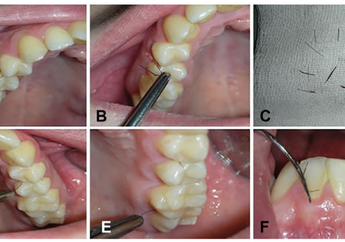 6 Tahun Tidak Periksa ke Dokter, Wanita Ini Kaget Temukan Rambut Bak Bulu Mata Kembali Muncul dari Sela-sela Gusinya, Setelah Dicek Ternyata...