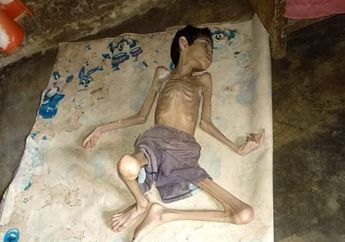 Tubuhnya Tinggal Tulang Belulang Akibat Gizi Buruk, Begini Nasib Tragis Pria 24 Tahun Ini Menghadapi Hidup