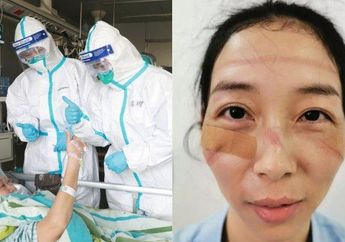 Terlalu Lama Pakai Helm dan Masker Pelindung karena NonStop Urusi Pasien Virus Corona, Lihat Wajah Para Dokter dan Staf Medis Ini, Lebam-lebam karena Lelah dan Stres 