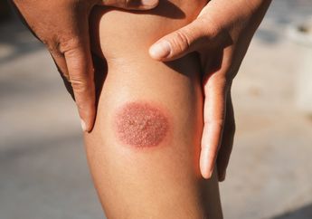 Segudang Manfaat Kunyit dan Madu, Bisa Hilangkan Luka Bakar, Lho!