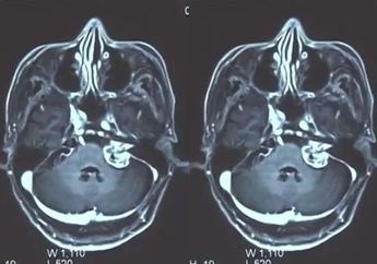 Rela Cabut 8 Giginya Demi Sembuh Dikira Sakit Gigi Biasa, Penderitaan Wanita Ini Justru Tak Kunjung Usai, Ternyata Inilah Penyakit Mengerikan yang Diidapnya