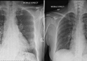 Berdasarkan Penelitian Terbaru Pasien Corona yang telah Sembuh akan Alami Penurunan Fungsi Paru-paru Selama Sisa Hidupnya! Begini Penjelasannya