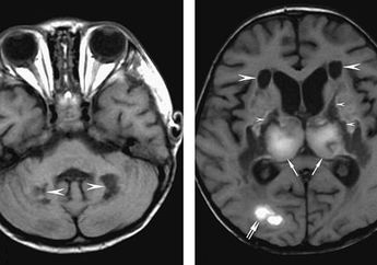 Penelitian Terbaru Menunjukkan bahwa Pasien Positif Corona juga Mengalami Kerusakan Otak yang Membuat Penderitanya Mengalami Hal Mengerikan Ini selama Hidupnya!