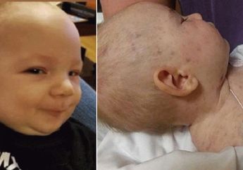 Dikira Hanya Ruam Popok, Siapa Sangka Bayi Ini Idap Meningitis Seperti yang Diderita Glenn Fredly, dan Langsung Meninggal