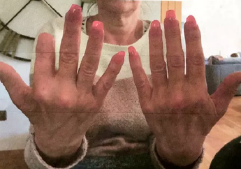 Menggerogoti Jari dan Tulangnya hingga Terancam Kehilangan Lengan, Nenek 57 Tahun Ini Harus Diamputasi Hanya Karena Hal Sepele Ini: Berubah Ungu dan Berair