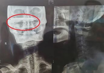 'Para Dokter Telah Memberi Saya Kesempatan Kedua dalam Hidup', Ini Cerita Seorang Pria yang 26 Tahun Hidup dengan Bilah Pisau 10 cm yang Menancap dalam Kepalanya