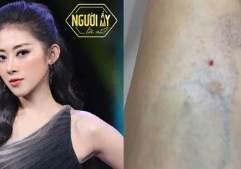 Hilangkan Bekas Gigitan Nyamuk dengan Suntik Filler Botox, Wanita Cantik Ini malah Alami Hal yang Mengerikan!