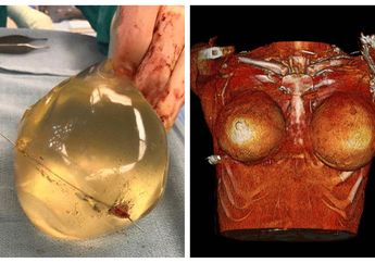 Ditembak dari Jarak Dekat, Seorang Wanita Selamat Berkat Implan Payudara, Peristiwa Mendebarkan Ini Menyita Perhatian Peneliti dan Membuat Petugas Medis Tak Percaya