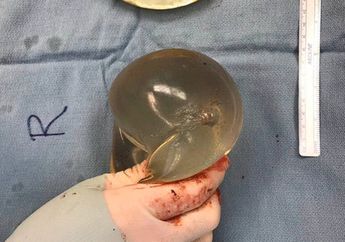 Meski Ditempat dari Jarak Dekat, Nyawa Wanita ini Masih Bisa Selamat Gara-gara Pelurunya Malah Nyangkut di Silikon Payudara, Begini Penjelasan Ahli...