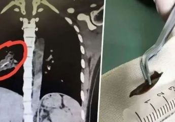 Batuk Parah selama 14 Tahun, Wanita Ini Kaget saat Melihat Hasil CT Scan, Ternyata Ada Benda yang Mengejutkan Ini di Dalam Tubuhnya!
