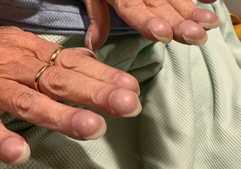 Ketahui Istilah Finger Clubbing, Perubahan Pada Kuku yang Bisa Jadi Indikasi Risiko Serangan Jantung