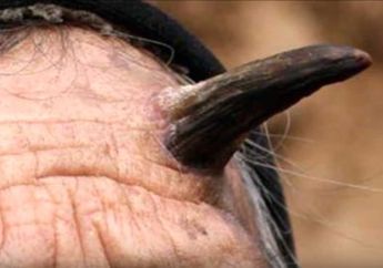 Tumbuh 'Tanduk Setan' di Kepalanya, Pria Berusia 74 Ini Berusaha Mencungkilnya Sendiri, Begini Asal-usul 'Tanduk' pada Manusia: Bisa Tumbuh di Mana Saja