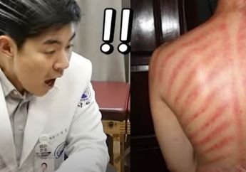 Baru Tahu Orang Indonesia Obati Masuk Angin Pakai Kerokan, Dirut Rumah Sakit Korea Selatan Syok Sekaligus Takjub: Bagaimana Bisa Simetris Begini?  &nbsp;