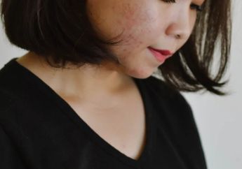 Begini Cara Mencegah Jerawat untuk Jenis Kulit Berminyak, Skincare DIY Jadi Pemicu?