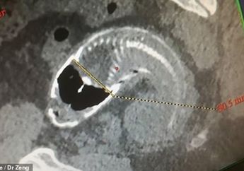 Mengerikan! Kesakitan saat Buang Air, Seekor Ikan Nila Ditemukan dalam Tubuh Pria Ini