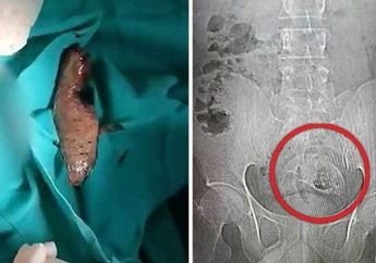 Aneh Tapi Nyata! Mengaku Tak Sengaja Mendudukinya, Seekor Ikan Nila Ditemukan Bersarang di Pantat Pria Ini hingga Membusuk