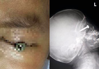 Hati-hati Saat Gunakan Mesin Pemotong Rumput, Bocah 3 Tahun Ini Nyaris Buta Usai Tak Sengaja 'Kelilipan' Sekrup yang Tiba-tiba Terlontar 