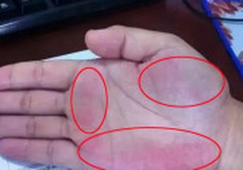 Hati-Hati Jika 3 Tanda Ini Muncul di Telapak Tangan Anda, Bisa Jadi Itu Menjadi Petanda Penyakit Mematikan Ini