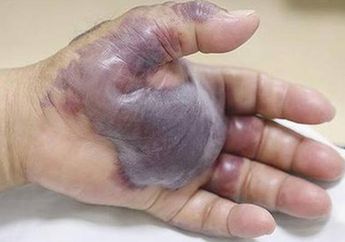 Tanpa Sakit Sedikitpun, Begini Cara Keluarkan Duri dan Serpihan Kayu dari Kulit