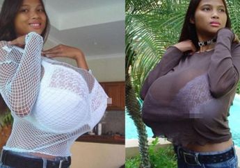 Menstruasi Saja Belum, Gadis Ini Mendadak Punya Payudara Berukuran Tak Masuk Akal Hanya Dalam 6 Bulan, Dokter Sampai Tercengang Begitu Memeriksanya